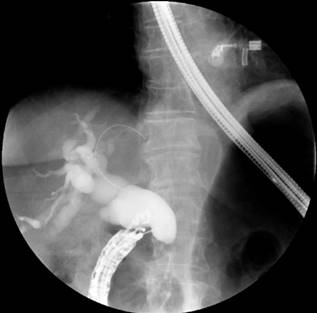 Canulación de la vía biliar guiada por endosonografía y fluoroscopia en la que se observa la dilatación con la amputación distal.