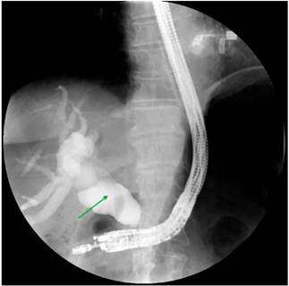 Stent metálico liberado bajo control por endosonografía y guía fluoroscópica.