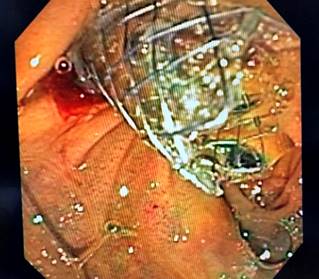 Resultado final de la derivación biliodigestiva guiada por USE.