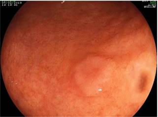Lesi&oacute;n 0-Is encontrada como hallazgo incidental en la endoscopia de v&iacute;as digestivas altas.