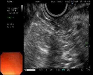 Ultrasonograf&iacute;a endosc&oacute;pica, lesi&oacute;n que llega hasta la segunda capa.