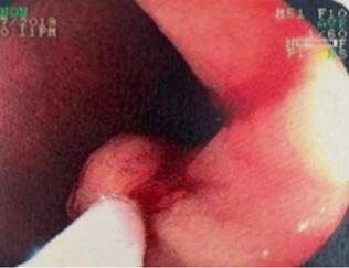 Resecci&oacute;n durante la mucosectom&iacute;a.