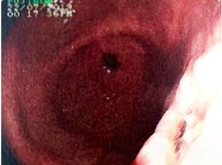 Lecho de la lesi&oacute;n.