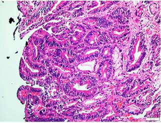 10x hematoxilina-eosina. Mucosa g&aacute;strica con reemplazo de la arquitectura normal por presencia de lesi&oacute;n tumoral maligna conformada por elementos glandulares y tubulares, revestidos por epitelio columnar alto focalmente pseudoestratificado con moderado pleomorfismo e hipercromatismo nuclear.