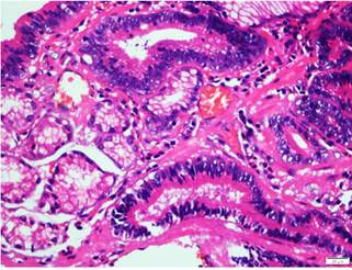 40x hematoxilina-eosina. Se observan elementos glandulares tubulares en cercan&iacute;a de fibra muscular lisa de la muscular de la mucosa. Adyacente se encuentra componente glandular normal.
