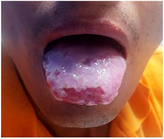 Presencia de aftas bucales en la lengua