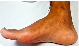 Lesiones eritematosas en la parte interna del pie derecho