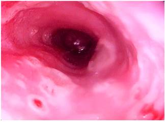 Videoendoscopia alta en la que se muestra la presencia de &uacute;lceras de 5 mm con bordes sobreelevados con fondo eritematoso en el es&oacute;fago distal