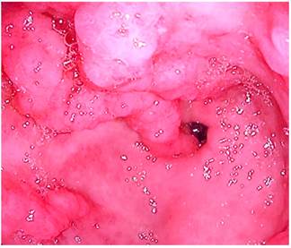 Videoendoscopia alta a nivel de antro en la que se muestra la presencia de engrosamiento de los pliegues prepil&oacute;ricos con presencia de eritema y edema