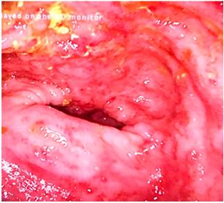 Colonoscopia a nivel todo el colon en la que se observa alteraci&oacute;n del patr&oacute;n vascular, mucosa, eritema granular y edema friable con presencia de &uacute;lceras superficiales a nivel del colon sigmoide