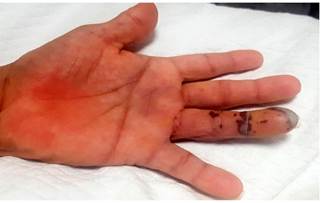 Lesiones d&eacute;rmicas petequiales y necr&oacute;ticas en el cuarto dedo de la mano izquierda