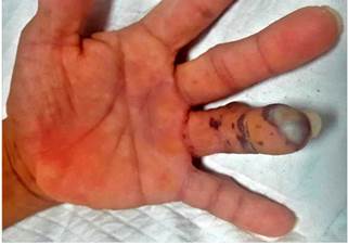 Lesi&oacute;n necr&oacute;tica con &aacute;rea blanquecina en la parte distal del cuarto dedo de la mano izquierda