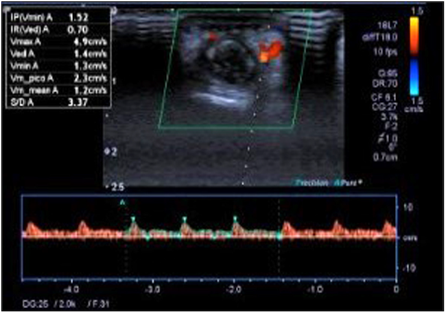 Ecograf&iacute;a Doppler del miembro superior, fluidos disminuidos con ondas parvus tardus en las arterias digitales palmares y dorsales del cuarto dedo de la mano izquierda