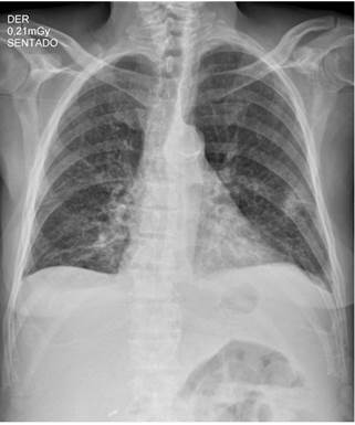 Radiograf&iacute;a anteroposterior (AP) de t&oacute;rax que muestra opacidades intersticiales reticulares gruesas en ambos campos pulmonares y &aacute;ngulos costofr&eacute;nicos libres