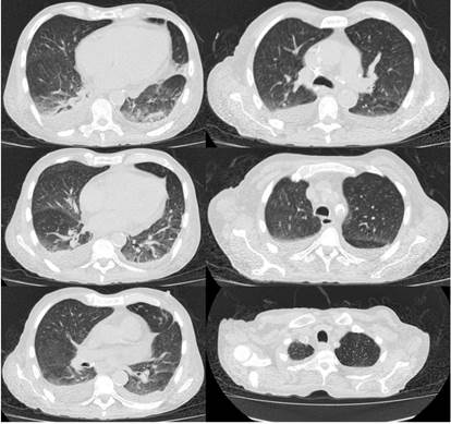 Tomograf&iacute;a axial computarizada de alta resoluci&oacute;n (TACAR) de t&oacute;rax que evidencia silicoantracosis, atelectasia de l&oacute;bulos inferiores y alteraci&oacute;n en la densidad de cuerpos vertebrales y estern&oacute;n
