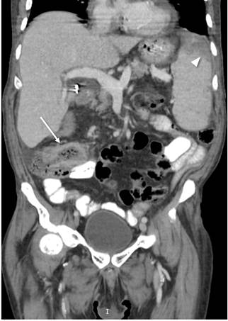 Tomograf&iacute;a de abdomen que evidencia engrosamiento de la pared del &iacute;leon distal (flecha blanca) e im&aacute;genes hipodensas subcapsulares correspondientes a infartos (cabeza de flecha)