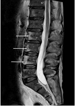Resonancia magn&eacute;tica nuclear (RMN) de columna lumbar que evidencia lesiones focales de aspecto l&iacute;tico en L2, L3 y L4 (flechas blancas)