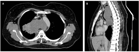 TAC de t&oacute;rax contrastado. Masa en el mediastino medio de 128 x 66 x 84 mm en di&aacute;metros L x AP x T, respectivamente, sin realce significativo posterior a la administraci&oacute;n de medio de contraste, homog&eacute;nea, de contornos parcialmente definidos lobulados, con extensi&oacute;n desde C7 hasta T7 con un efecto compresivo sobre las estructuras mediastinales adyacentes, en especial con la tr&aacute;quea que desplaza el tejido en sentido anterior con disminuci&oacute;n de su calibre sobre un 73 % aproximadamente; y en el es&oacute;fago, donde se aprecia parcialmente su luz. Ganglios linf&aacute;ticos subcentim&eacute;tricos de localizaci&oacute;n prevascular, el de mayor tama&ntilde;o con eje corto de 8 mm; a nivel paraa&oacute;rtico se observan ganglios linf&aacute;ticos con eje corto de 10 mm. A. Corte axial. B. Reconstrucci&oacute;n sagital