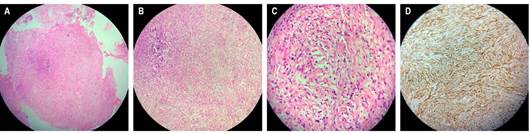 Estudio microsc&oacute;pico. Lesi&oacute;n neopl&aacute;sica constituida por c&eacute;lulas fusiformes y algunas pleom&oacute;rficas sobre un estroma fibrocol&aacute;geno asociado con la presencia de infiltrado inflamatorio linfoc&iacute;tico. A. Tinci&oacute;n con hematoxilina-eosina (HE; aumento x 4). B. Tinci&oacute;n con HE (aumento x 10). C. Tinci&oacute;n con HE (aumento x 40). D. Inmunohistoqu&iacute;mica para prote&iacute;na S100 positivo