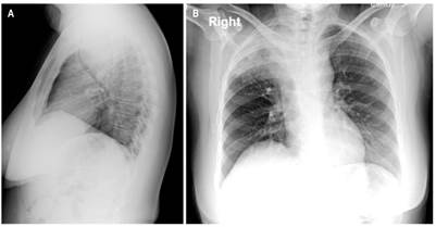 RX de t&oacute;rax. Masa en el mediastino medio, con un componente a&eacute;reo interno en su aspecto superior que no descarta cavitaci&oacute;n; esta imagen se comunica con consolidaci&oacute;n adyacente del l&oacute;bulo superior derecho, lo cual no descarta un trayecto fistuloso. La masa genera un importante efecto compresivo sobre las estructuras adyacentes, especialmente sobre la tr&aacute;quea, la cual disminuye su calibre en un 73 % aproximadamente. Masa con compromiso de la pleura mediastinal y el par&eacute;nquima pulmonar apical derecho en contacto con la arteria pulmonar derecha, cayado a&oacute;rtico y cayado de la vena &aacute;cigos sin signos de infiltraci&oacute;n. A. Proyecci&oacute;n lateral. B. Proyecci&oacute;n posteroanterior