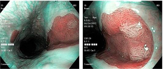 Parche de mucosa g&aacute;strica ect&oacute;pica en el es&oacute;fago cervical, con 2 islas de tejido de aspecto adenomatoso (NBI)