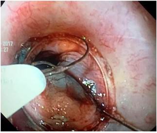 Mucosectom&iacute;a con EMR kit