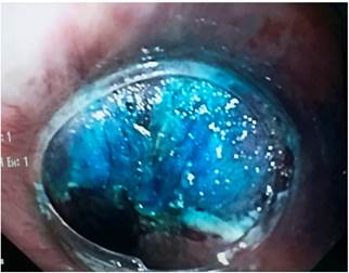 Imagen endosc&oacute;pica posmucosectom&iacute;a. Lesi&oacute;n completa-mente resecada