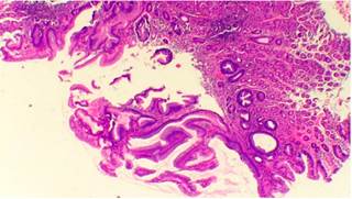 Imagen microsc&oacute;pica. Tinci&oacute;n hematoxilina-eosina: aumento de 10 x. Hallazgos compatibles con adenoma velloso