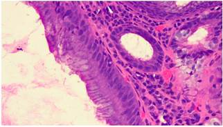 Imagen microsc&oacute;pica. Tinci&oacute;n hematoxilina-eosina, aumento de 40 x. Hallazgos compatibles con adenoma velloso