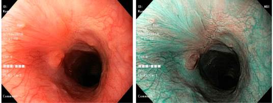Im&aacute;genes endosc&oacute;picas de control, resecci&oacute;n de adenoma velloso
