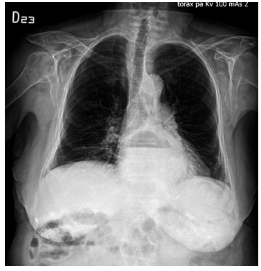 Radiograf&iacute;a de t&oacute;rax: Se identifica ascenso de la c&aacute;mara g&aacute;strica en el mediastino posterior, con nivel hidroa&eacute;reo