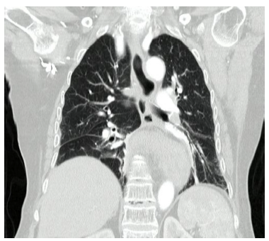 Escanograf&iacute;a de t&oacute;rax: se observa hernia de la uni&oacute;n gastroesof&aacute;gica, fondo y uni&oacute;n antropil&oacute;rica del est&oacute;mago hacia el t&oacute;rax, adem&aacute;s de rotaci&oacute;n del est&oacute;mago en su eje largo