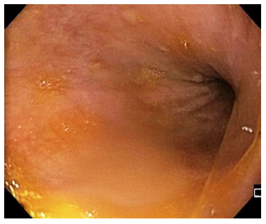 Imagen durante realizaci&oacute;n de endoscopia de v&iacute;as digestivas altas y devolvulaci&oacute;n endosc&oacute;pica