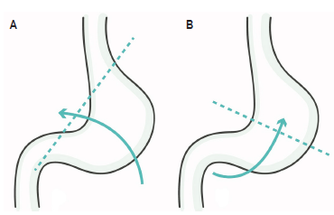 A. V&oacute;lvulo organoaxial por rotaci&oacute;n del est&oacute;mago sobre su eje longitudinal. B. V&oacute;lvulo mesenteroaxial por rotaci&oacute;n del est&oacute;mago sobre su eje transverso