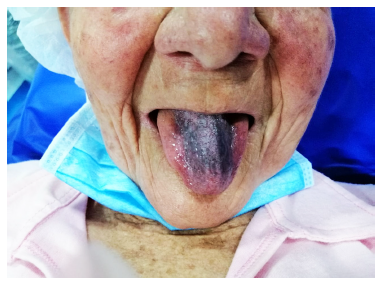 Paciente con coloraci&oacute;n negra del dorso de la lengua, que no compromete los bordes laterales ni la punta