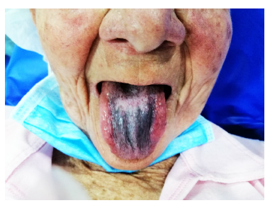 Paciente con lengua negra pilosa (LNP), con despigmentaci&oacute;n blanquecina en la parte central posterior