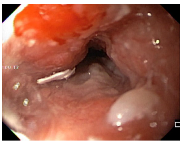 Endoscopia. Borde proximal de carcinoma escamocelular de es&oacute;fago medio que compromete el 80% de la pared y de la luz