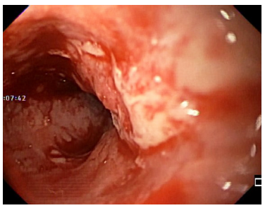 Endoscopia. Borde distal del carcinoma de es&oacute;fago medio