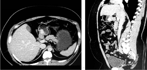 Imagen por TAC en la que se evidencia, en la regi&oacute;n antral, la presencia de una lesi&oacute;n s&oacute;lida exof&iacute;tica de contornos lobulados que capta el contraste, con un di&aacute;metro de 17 x 20 mm, y que podr&iacute;a estar relacionada con un tumor de GIST.