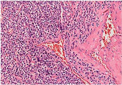 Tumor gl&oacute;mico. Vaso sangu&iacute;neo central rodeado por c&eacute;lulas tumorales homog&eacute;neas con n&uacute;cleo redondo y citoplasma claro. El estudio de inmunohistoqu&iacute;mica con actina de m&uacute;sculo liso mostr&oacute; positividad fuerte y difusa en las c&eacute;lulas tumorales (hematoxilina-eosina [H y E] 40x).