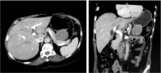 TAC abdominal en la que se evidencia una masa en la curvatura menor del est&oacute;mago que se proyecta hacia el mesenterio, con una medida aproximada de 50 mm, GIST.