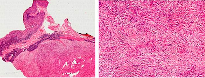 Cuerpo g&aacute;strico con tumor benigno que se origina en la muscular. El tumor est&aacute; constituido por zonas hipercelulares de c&eacute;lulas fusiformes (Antoni A), alternando con zonas hipocelulares de c&eacute;lulas ovoides (Antoni B). Las c&eacute;lulas tumorales presentan reactividad fuerte y difusa para la prote&iacute;na S100 (H y E 5x y 40x).