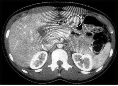 TAC abdominal que reporta una masa qu&iacute;stica exof&iacute;tica multiloculada de paredes y tabiques gruesos e irregulares de 3 cm al parecer originada en el ligamento gastrohep&aacute;tico, con alteraci&oacute;n de la grasa adyacente.