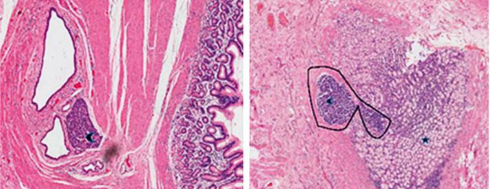 Los hallazgos patol&oacute;gicos del esp&eacute;cimen resecado mostraron un p&aacute;ncreas heterot&oacute;pico, localizado en lo profundo de la capa muscular del antro, asociado con la presencia de estructuras glandulares y cambios qu&iacute;sticos. El reporte indic&oacute; un cistoadenoma mucinoso originado en el tejido pancre&aacute;tico ect&oacute;pico.