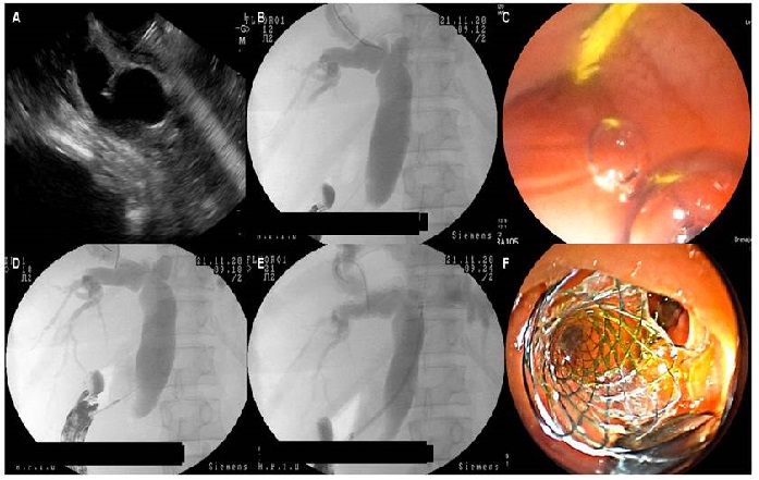 Coledocoduodenostom&iacute;a USE-guiada. A. Punci&oacute;n transduodenal del col&eacute;doco con aguja 19 G. B. Visi&oacute;n fluorosc&oacute;pica de una colangiograf&iacute;a USE-guiada. C. Visi&oacute;n endosc&oacute;pica de la gu&iacute;a hidrof&iacute;lica en el duodeno, n&oacute;tese el retorno escaso del medio de contraste por el orificio. D. Visi&oacute;n fluorosc&oacute;pica del momento del corte y paso del cistotomo de 6 Fr al col&eacute;doco. E. Paso del stent met&aacute;lico bajo visi&oacute;n fluorosc&oacute;pica. F. Visi&oacute;n endosc&oacute;pica del drenaje biliar, en el que se observa la parte distal (transduodenal) del stent. Im&aacute;genes obtenidas en el Hospital Pablo Tob&oacute;n Uribe.