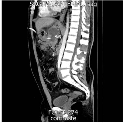 Drenaje transg&aacute;strico (corte sagital).
