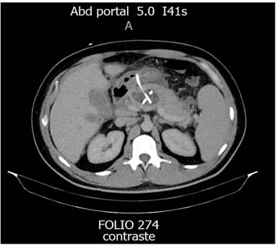 Drenaje transg&aacute;strico.