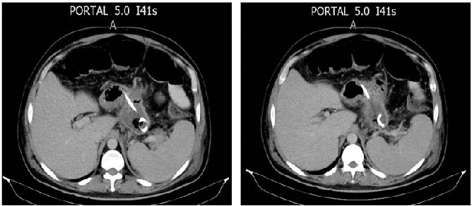 Cat&eacute;ter transg&aacute;strico percut&aacute;neo internalizado.