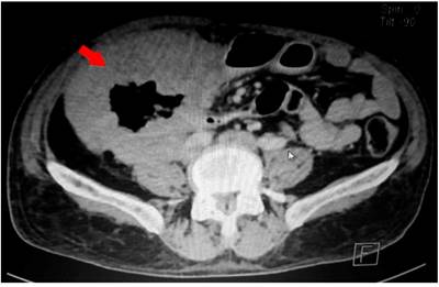 TAC de abdomen en corte transversal. Se observa un engrosamiento de la pared del colon derecho, como se observa en la flecha roja.