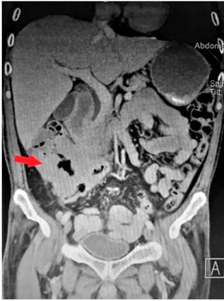 TAC de abdomen en corte coronal en la que se observa un engrosamiento de la pared del colon derecho con alteraci&oacute;n de la grasa pericecal, como se observa en la flecha roja.